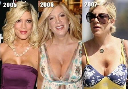 Tori Spelling Autors: Khalifa 12 Sliktākās plastiskās operācijas