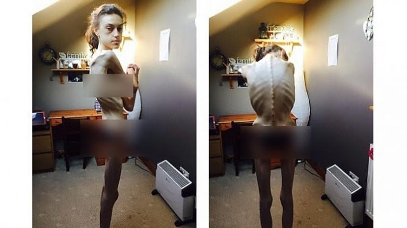 Kad viņa atkal nonāca... Autors: Bitchere Anorektiķes atzīšanās: Kā Instagrams izglāba manu dzīvību