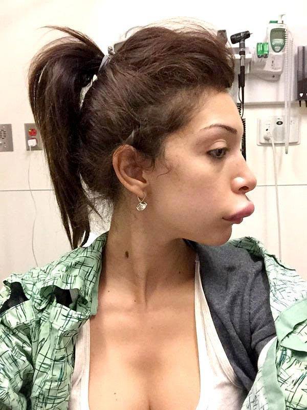 Autors: matilde Cilvēki, kuri vēlējās sev lielas lūpas, bet kaut kas nogāja greizi