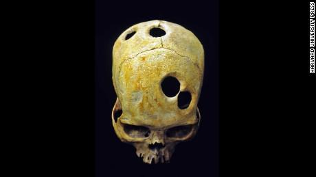 Trepanācija jeb caurumu... Autors: The Diāna Izglītojoši: Neparasti skeleti, kuri ilustrē slimības un procesus